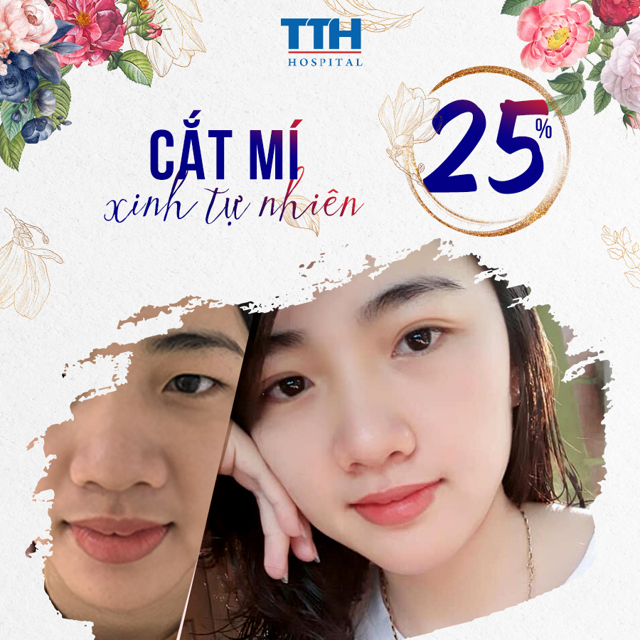 ƯU ĐÃI PHẪU THUẬT THẨM MỸ MẮT THÁNG 04/2021